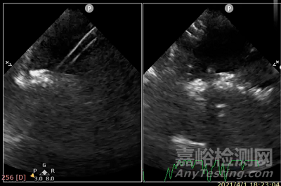 葛均波院士團(tuán)隊(duì)首創(chuàng)可穿刺放入的房缺封堵器