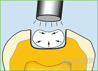 牙科粘合劑發(fā)展歷史及現(xiàn)狀