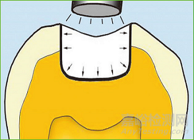 牙科粘合劑發(fā)展歷史及現(xiàn)狀