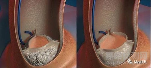 GEMINI：主動脈瓣雙頻率超聲除鈣技術(shù)