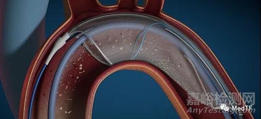 GEMINI：主動脈瓣雙頻率超聲除鈣技術(shù)