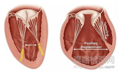 V-sling:經(jīng)導(dǎo)管左心室乳頭肌修復(fù)治療心衰