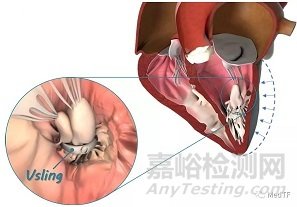 V-sling:經(jīng)導(dǎo)管左心室乳頭肌修復(fù)治療心衰