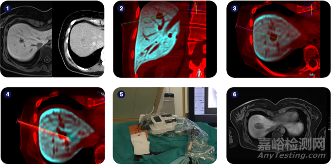 適用于任何CT及熒光內(nèi)鏡的介入機(jī)器人獲FDA批準(zhǔn)
