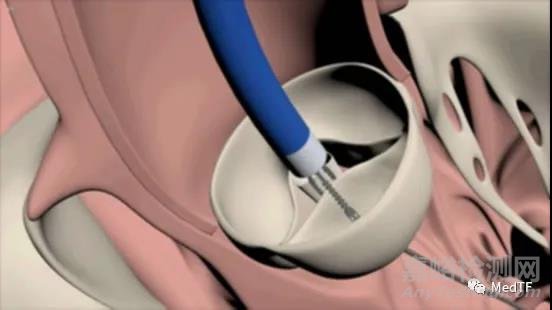 心臟瓣膜關(guān)閉不全問題的解決方案