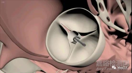 心臟瓣膜關(guān)閉不全問題的解決方案