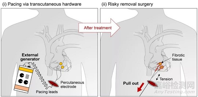 史上首個(gè)瞬時(shí)起搏器誕生！自動(dòng)無害降解