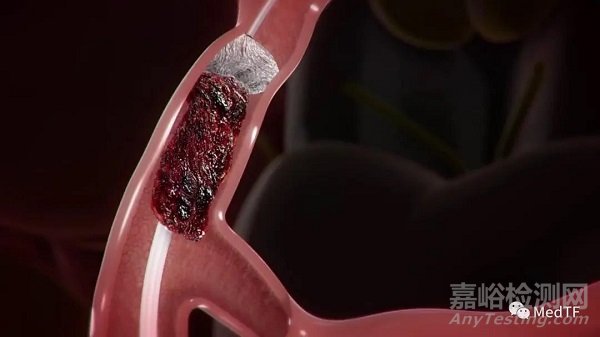 DAISe:取栓不只是支架和抽吸