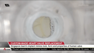 SingValve：首款允許私人定制的二尖瓣瓣膜