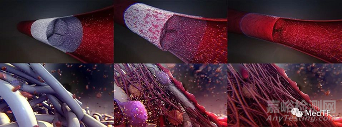 Xeltis PV極有可能重新定義心臟瓣膜