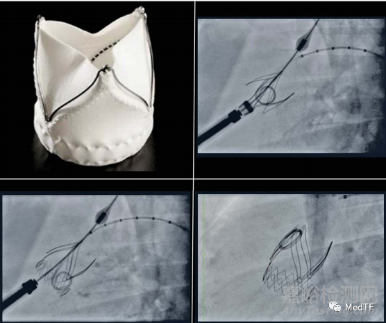 Xeltis PV極有可能重新定義心臟瓣膜