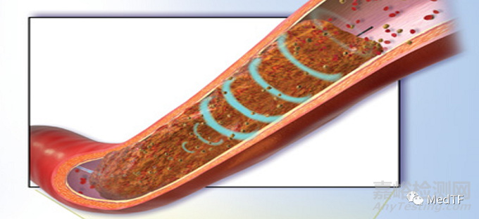 WaveClear System:血管閉塞超聲新療法