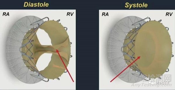 TRISOL VALVE：整體式瓣葉的三尖瓣