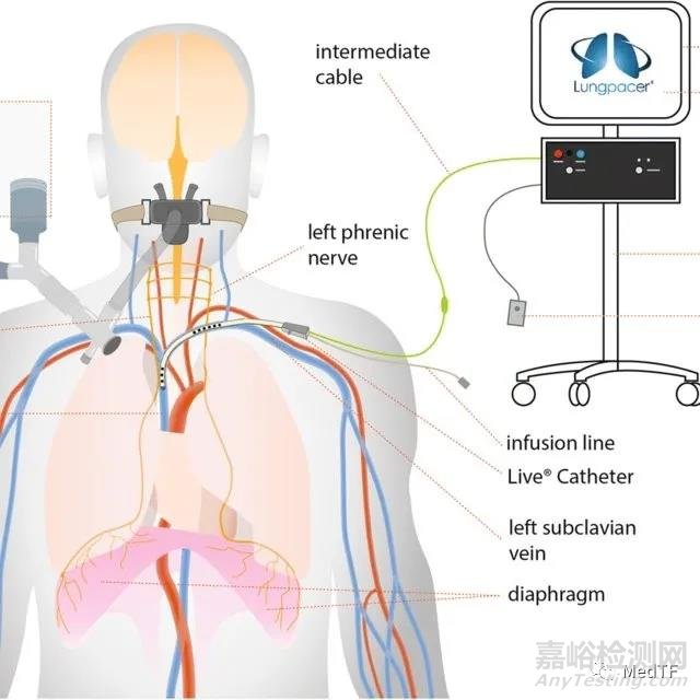 Lungpacer DPT ：機械通氣新方法