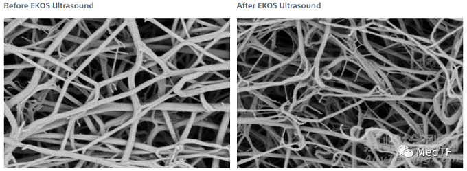 波科對(duì)治療肺栓塞(PE)的EkoSonic啟動(dòng)大規(guī)模臨床研究