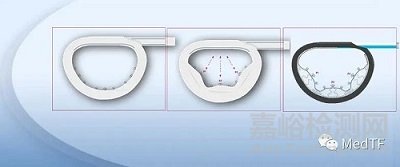 Kalios：隨時可以自由調節(jié)二尖瓣瓣環(huán)