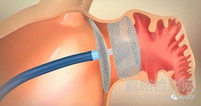 Amplatzer Amulet ：第二款左心耳封堵器獲FDA批準上市