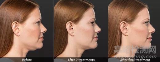 溶脂針合法化進(jìn)程加速