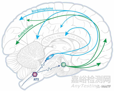 Vivistim：FDA 批準首個中風康復器械---迷走神經(jīng)刺激
