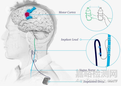 Vivistim：FDA 批準首個中風康復器械---迷走神經(jīng)刺激