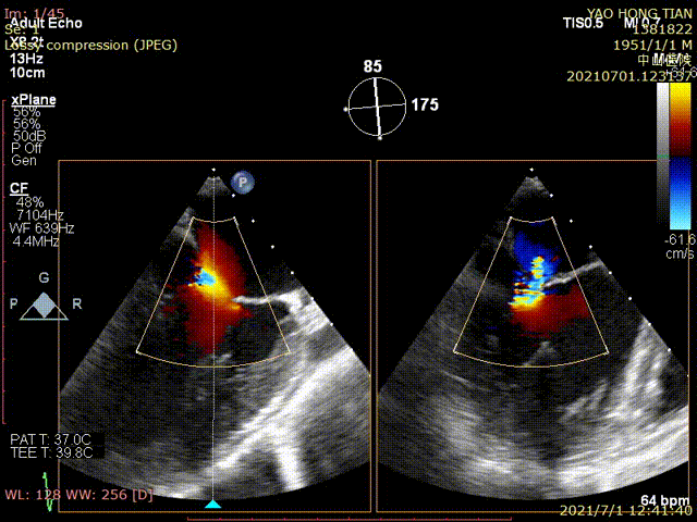 ValveClamp 完成10例功能性二尖瓣反流探索性臨床研究