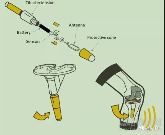 FDA批準(zhǔn)首款智能膝關(guān)節(jié)-Persona IQ