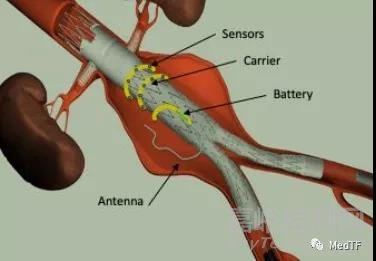 FDA批準(zhǔn)首款智能膝關(guān)節(jié)-Persona IQ