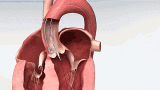 心通醫(yī)療可回收瓣膜系統(tǒng)VitaFlow Liberty獲NMPA批準(zhǔn)上市！