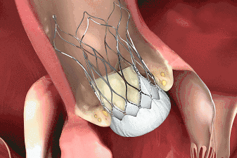心通醫(yī)療可回收瓣膜系統(tǒng)VitaFlow Liberty獲NMPA批準(zhǔn)上市！