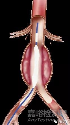 Nectero EAST:膠水修復腹主動脈瘤