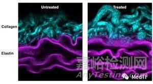 Nectero EAST:膠水修復腹主動脈瘤