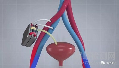 加州大學(xué)的人工腎：腎衰竭患者無需透析