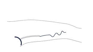 Sonovein:全球首款無創(chuàng)靜脈曲張治療機器人