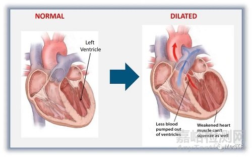 TCMR:心肌注入水凝膠治療心衰