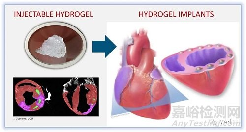 TCMR:心肌注入水凝膠治療心衰