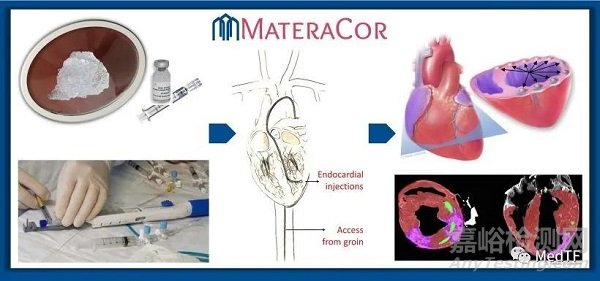 TCMR:心肌注入水凝膠治療心衰