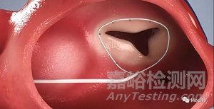 DaVingi：大小可調(diào)經(jīng)導管三尖瓣瓣環(huán)