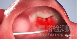 DaVingi：大小可調(diào)經(jīng)導管三尖瓣瓣環(huán)