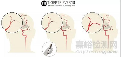 TIGERTRIEVER13:最小取栓支架 開啟腦遠端區(qū)域卒中治療
