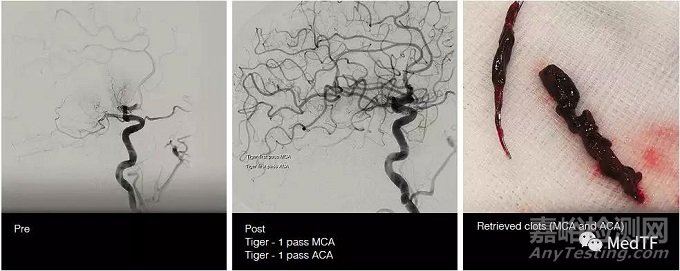 TIGERTRIEVER13:最小取栓支架 開啟腦遠端區(qū)域卒中治療