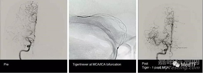 TIGERTRIEVER13:最小取栓支架 開啟腦遠端區(qū)域卒中治療