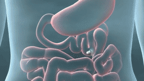 PillCam SB3 Home: 美敦力家用版膠囊內(nèi)鏡獲FDA批準上市 開啟內(nèi)鏡家用時代