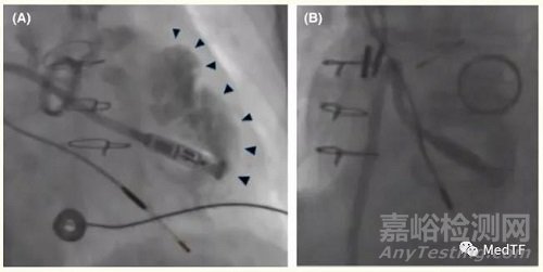 FDA警告無線起搏器可能因心臟穿孔引起嚴(yán)重并發(fā)癥