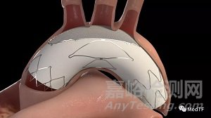 SYNAXIS:主動脈弓過濾器 開啟全新中風預(yù)防理念