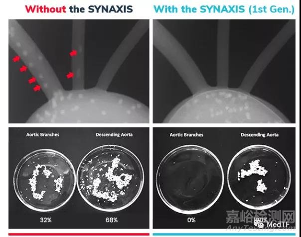 SYNAXIS:主動脈弓過濾器 開啟全新中風預(yù)防理念