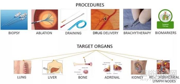 XACT ACE:完成第一例遠(yuǎn)程腫瘤介入手術(shù)