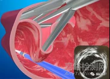 BlueLeaf：首款介入“自然”靜脈瓣 獲FDA“突破性設(shè)備”稱號