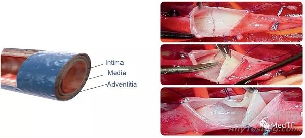 BlueLeaf：首款介入“自然”靜脈瓣 獲FDA“突破性設(shè)備”稱號