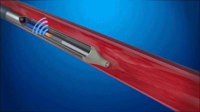 BlueLeaf：首款介入“自然”靜脈瓣 獲FDA“突破性設(shè)備”稱號