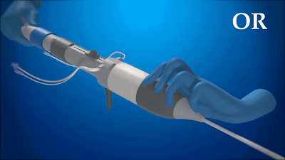 BlueLeaf：首款介入“自然”靜脈瓣 獲FDA“突破性設(shè)備”稱號